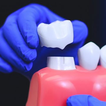 How to Care the Best for Your Dental Crowns: Tips for Long-Lasting Results