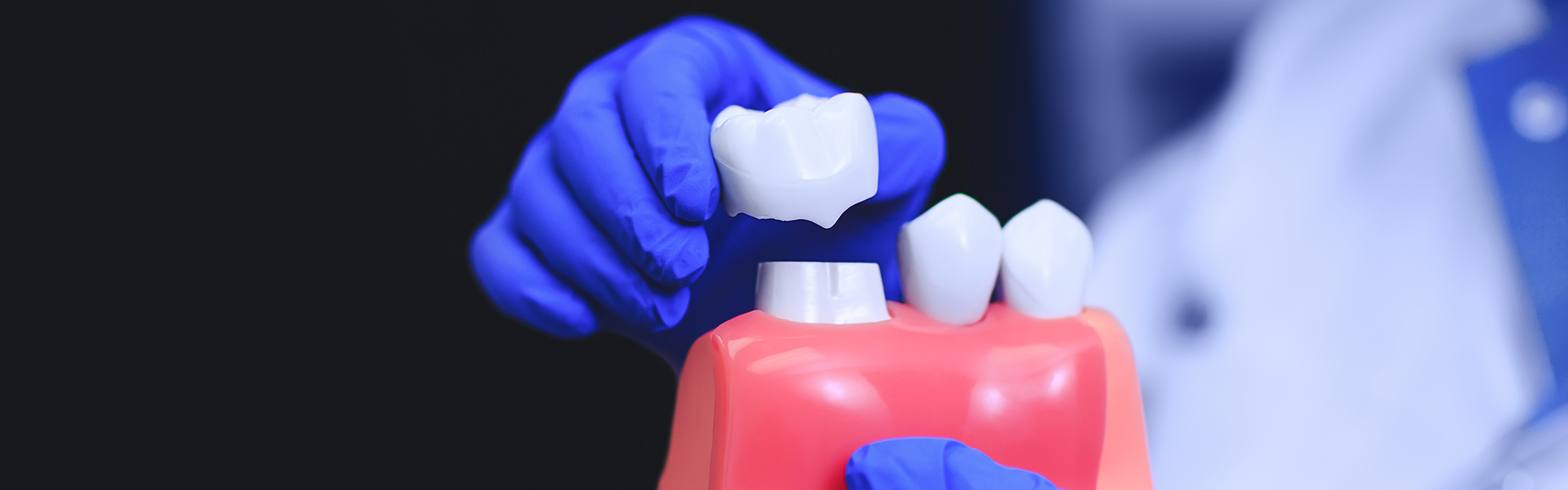 How to Care the Best for Your Dental Crowns: Tips for Long-Lasting Results