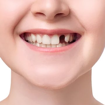 How Missing Teeth Impact Your Oral Health and How Implants Can Help