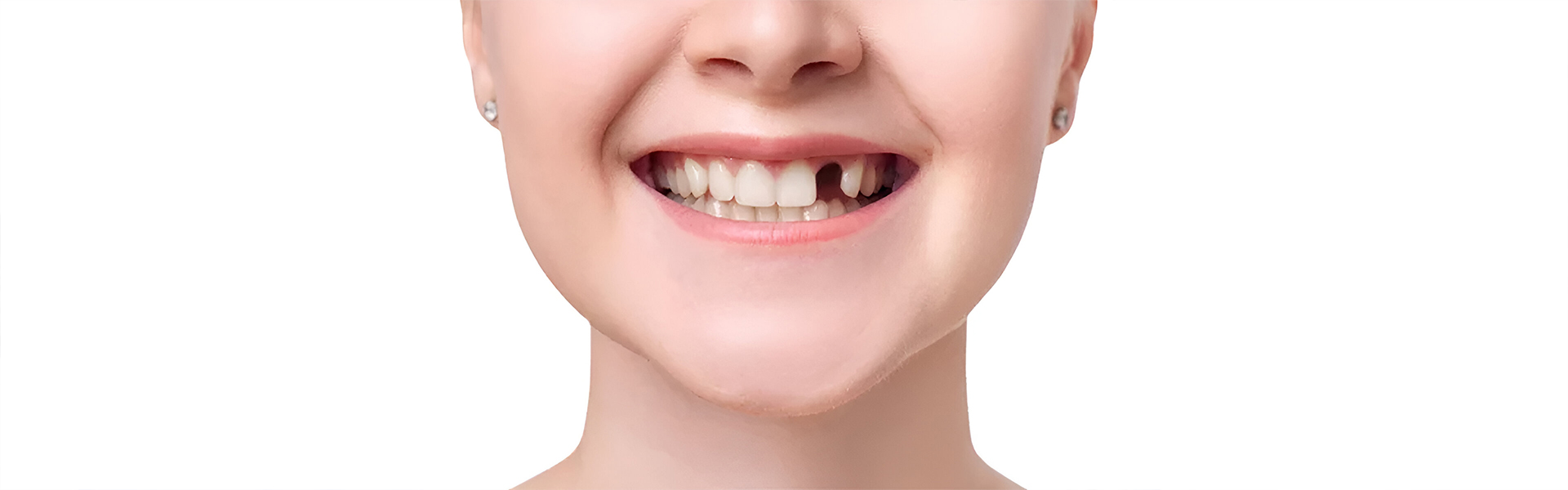 How Missing Teeth Impact Your Oral Health and How Implants Can Help