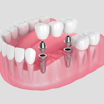 How Dental Bridges Help Prevent Further Oral Health Issues