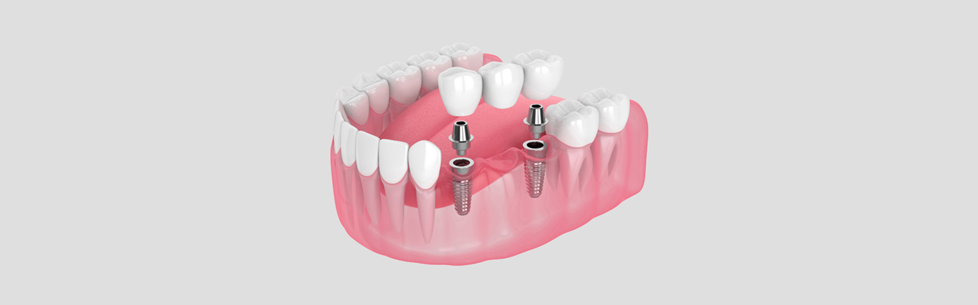 How Dental Bridges Help Prevent Further Oral Health Issues